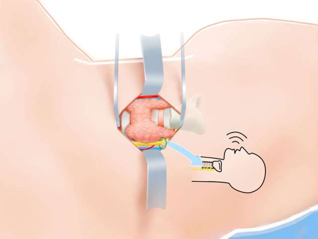 Thyroid Surgery